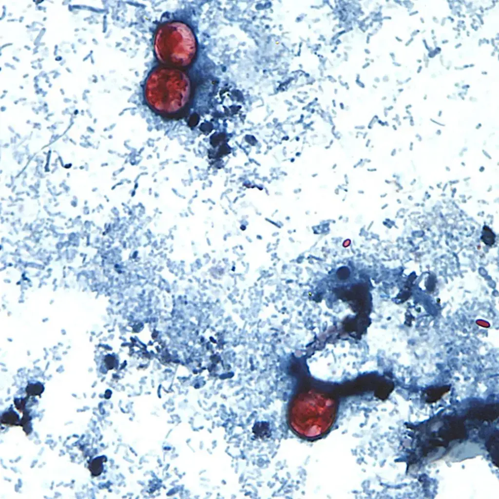 Mystery Deepens in Multi-State Cyclosporiasis Outbreak