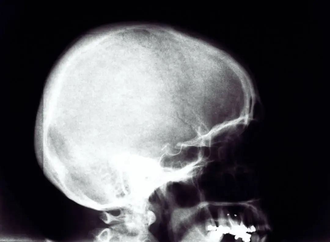 Scientists Identify Hidden Organ Within the Skull That May Aid Cancer Research